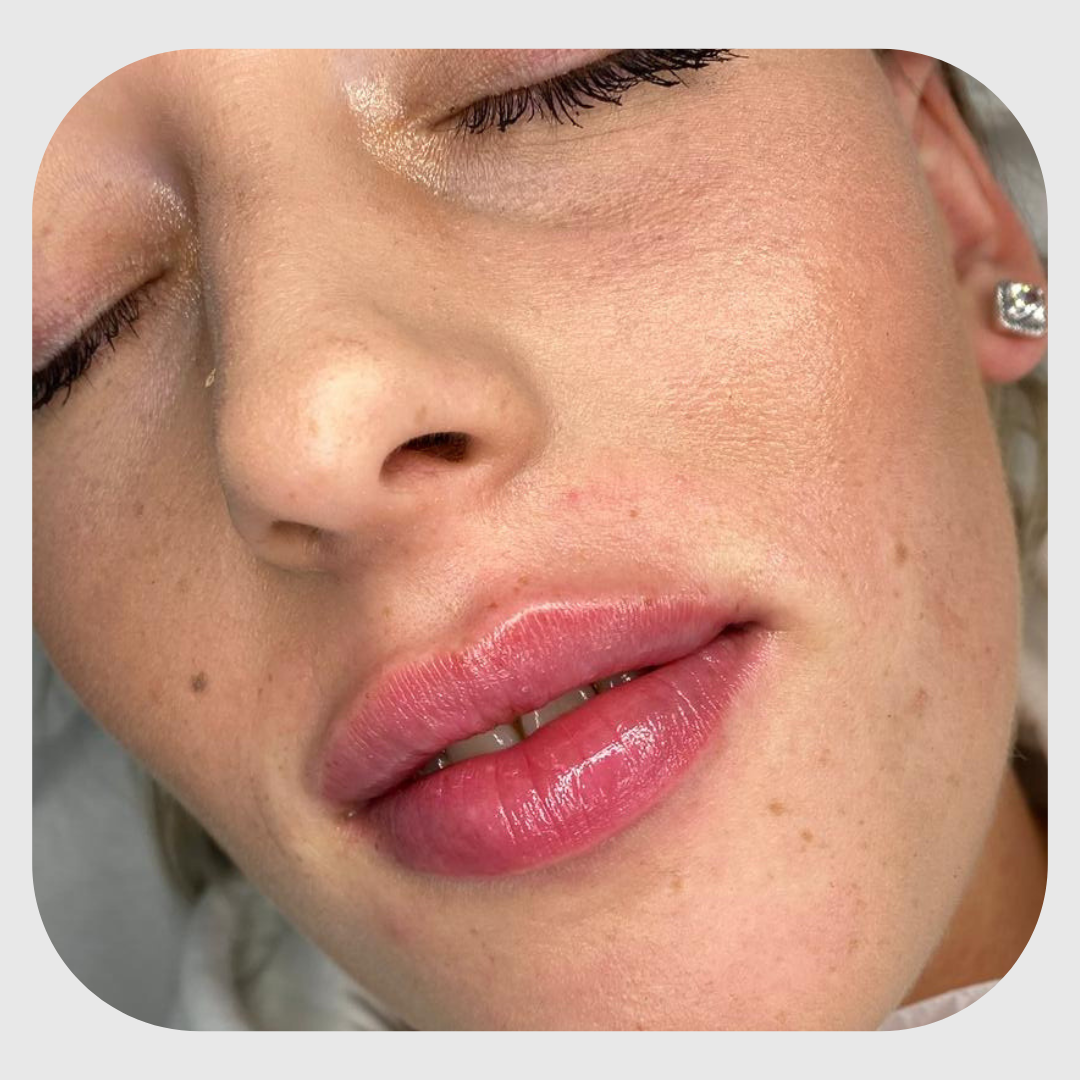 0.5ml Lip Filler