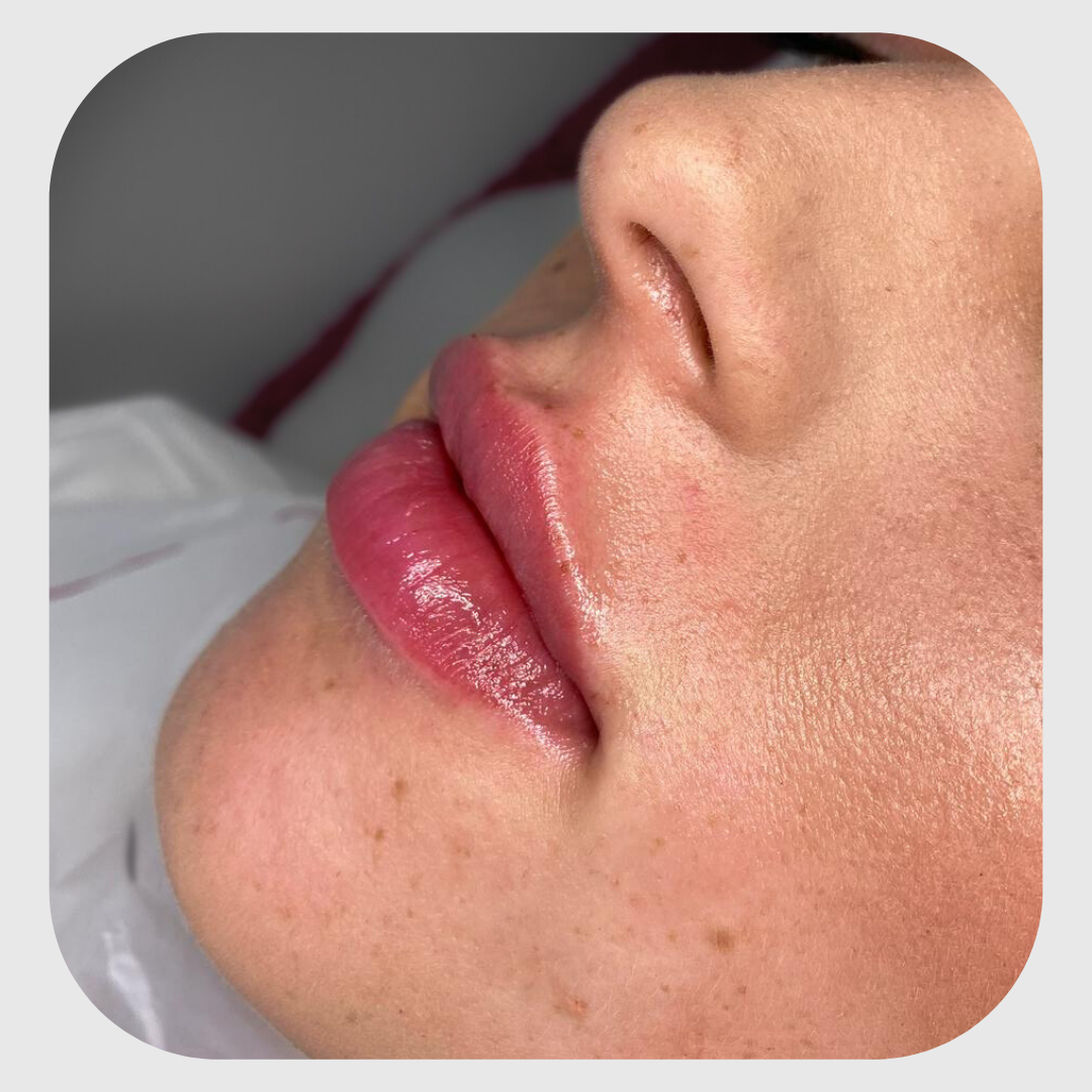 1ml Lip Filler