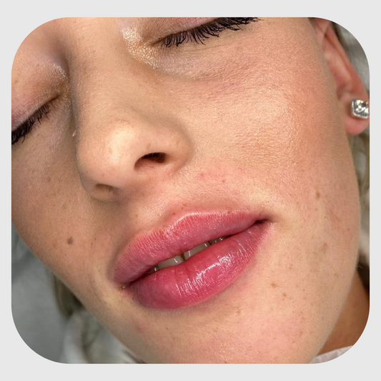0.5ml Lip Filler